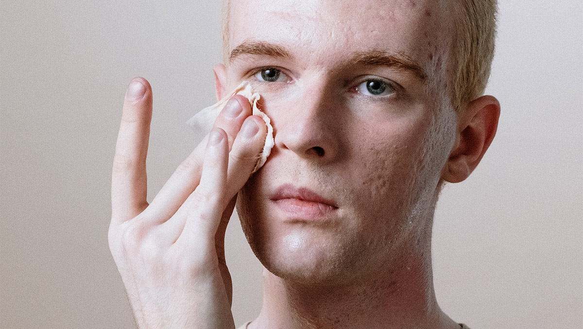 How to Maximize Your Acne Scar Healing