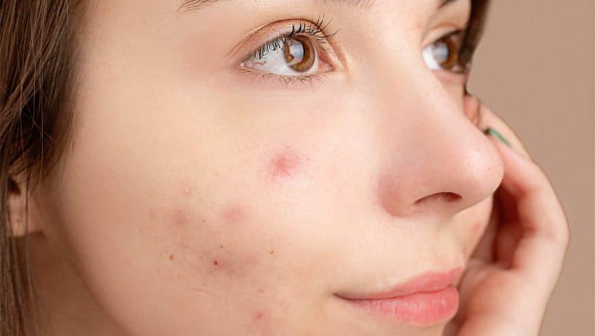 What is Acne Purging? Why Does it Happen?