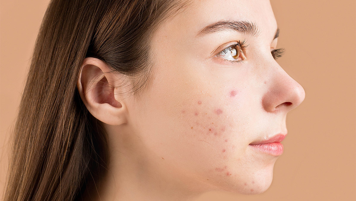 Why Choose an Acne Specialist Over a Dermatologist? The Answer May Surprise You!
